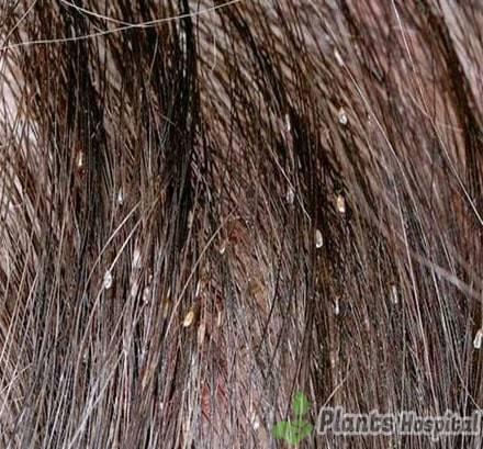 lice